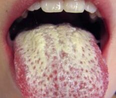 candida in the mouth