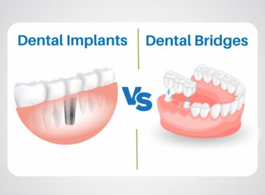 Dental Implants Vs Dental Bridges