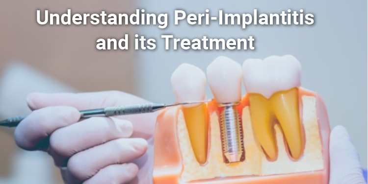 Understanding Peri-Implantitis and its Treatment